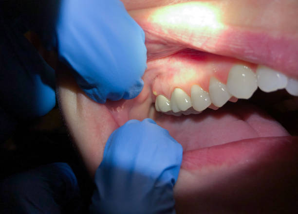 Best Emergency Wisdom Teeth Removal in Crane, MO